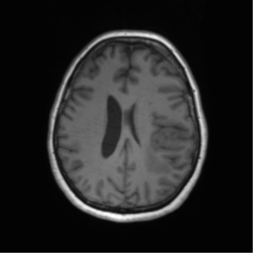Cerebral metastasis mimicking glioblastoma (Radiopaedia 69155-78937 Axial T1 43).png