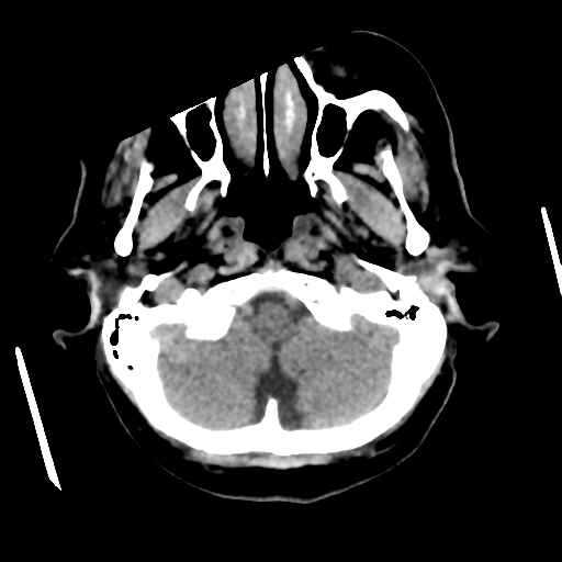 Cerebral metastasis to basal ganglia (Radiopaedia 81568-95412 Axial non-contrast 13).png