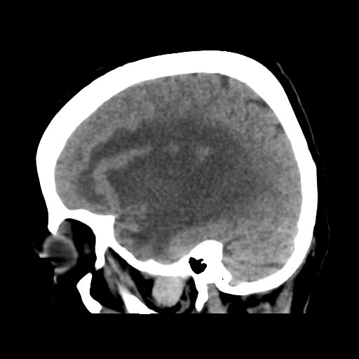 Cerebral metastasis to basal ganglia (Radiopaedia 81568-95412 E 19).png