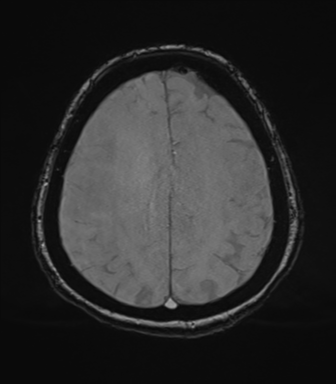Cerebral metastasis to basal ganglia (Radiopaedia 81568-95413 Axial SWI magnitude 66).png