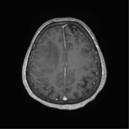 Cerebral metastasis to basal ganglia (Radiopaedia 81568-95413 Axial T1 C+ 55).png