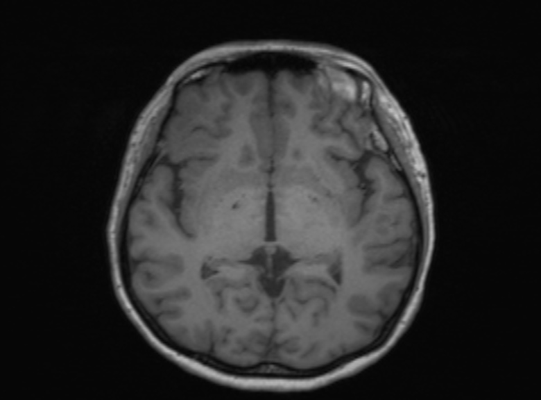Cerebral ring enhancing lesions - cerebral metastases (Radiopaedia 44922-48817 Axial T1 236).jpg