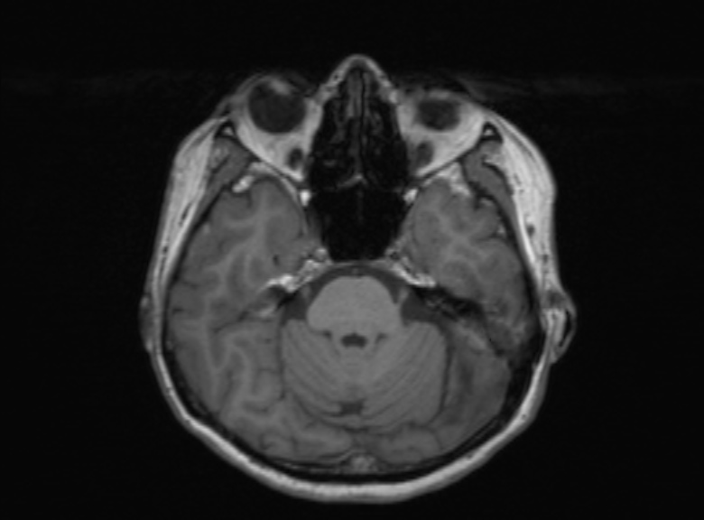 Cerebral ring enhancing lesions - cerebral metastases (Radiopaedia 44922-48817 Axial T1 284).jpg