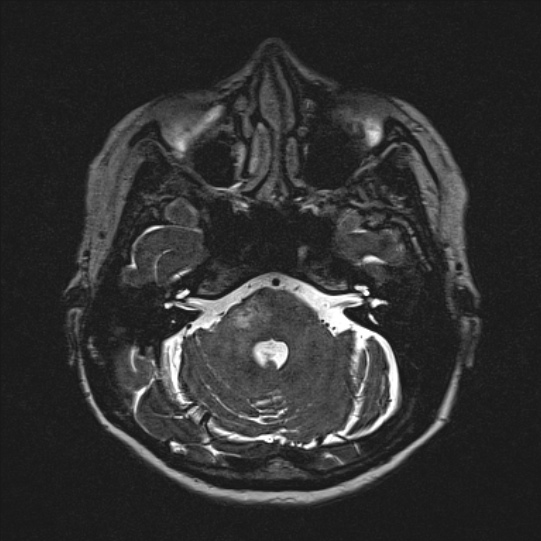 Cerebral ring enhancing lesions - cerebral metastases (Radiopaedia 44922-48817 F 36).jpg