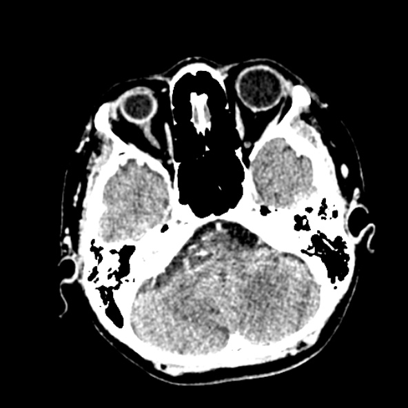 Cerebral ring enhancing lesions - cerebral metastases (Radiopaedia 44922-48818 B 73).jpg