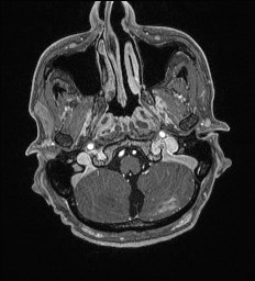 File:Cerebral toxoplasmosis (Radiopaedia 43956-47461 Axial T1 C+ 6).jpg