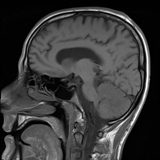 File:Cerebral toxoplasmosis (Radiopaedia 43956-47461 Sagittal T1 9).jpg