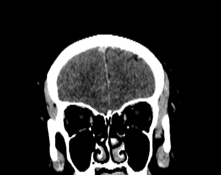 Cerebral venous hemorrhagic infarct from venous sinus thrombosis (Radiopaedia 55433-61883 Coronal C+ delayed 18).jpg