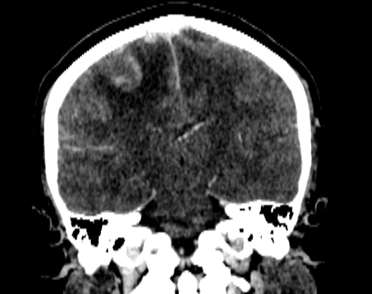 File:Cerebral venous hemorrhagic infarct from venous sinus thrombosis (Radiopaedia 55433-61883 Coronal C+ delayed 37).jpg