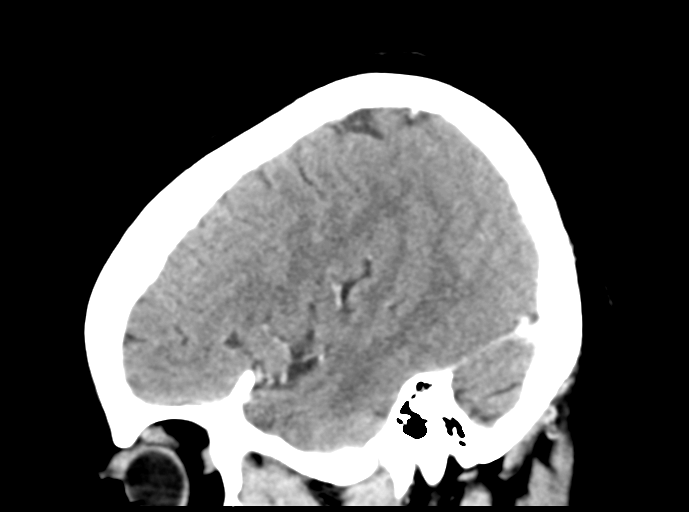Cerebral venous hemorrhagic infarction (Radiopaedia 57576-64538 Sagittal C+ 41).png