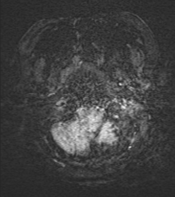 Cerebral venous infarct (Radiopaedia 53627-59685 Axial SWI 2).jpg