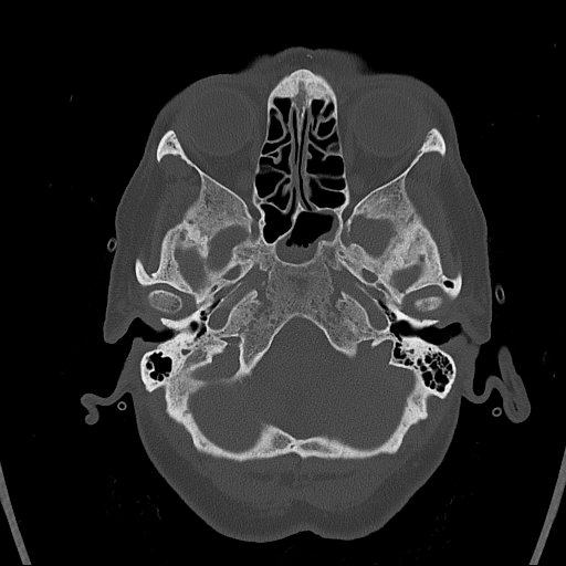 Cerebral venous infarction with hemorrhage (Radiopaedia 65343-74381 Axial bone window 16).jpg