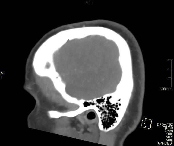 File:Cerebral venous sinus thrombosis (Radiopaedia 91329-108965 Sagittal venogram 11).jpg