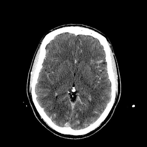 File:Cerebral venous thrombosis (CVT) (Radiopaedia 77524-89685 Axial with contrast 19).jpg