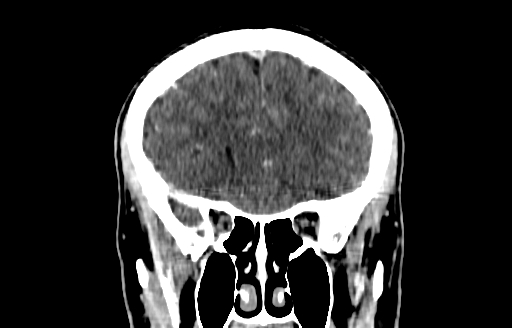 Cerebral venous thrombosis (CVT) (Radiopaedia 77524-89685 C 17).jpg