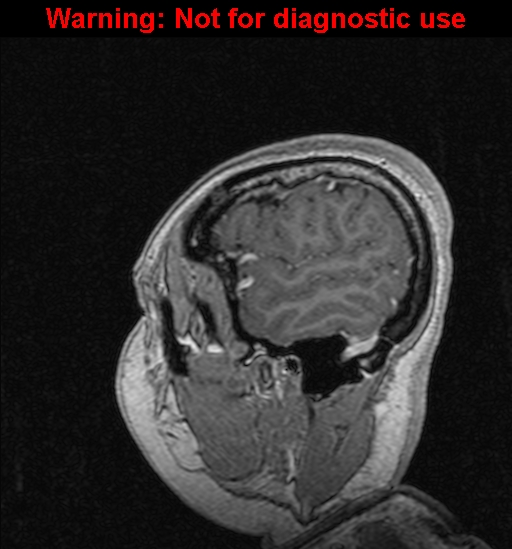 Cerebral venous thrombosis (Radiopaedia 37224-39208 Sagittal T1 C+ 22).jpg