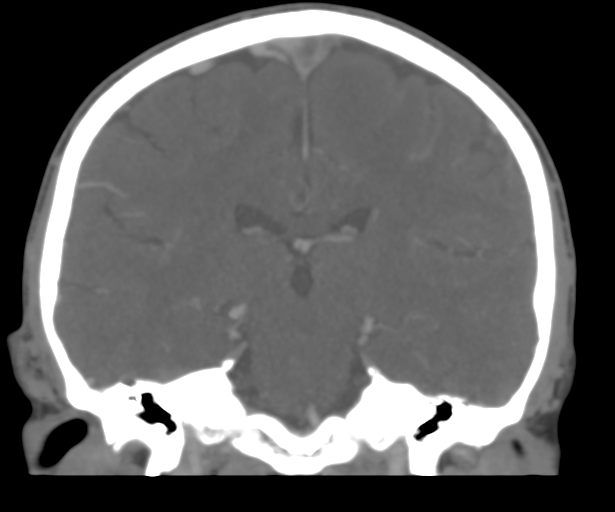 File:Cerebral venous thrombosis (Radiopaedia 38392-40467 Coronal CTA-Venogram 36).png