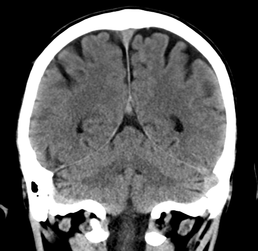 File:Cerebral venous thrombosis (Radiopaedia 38392-40467 Coronal non-contrast 27).png