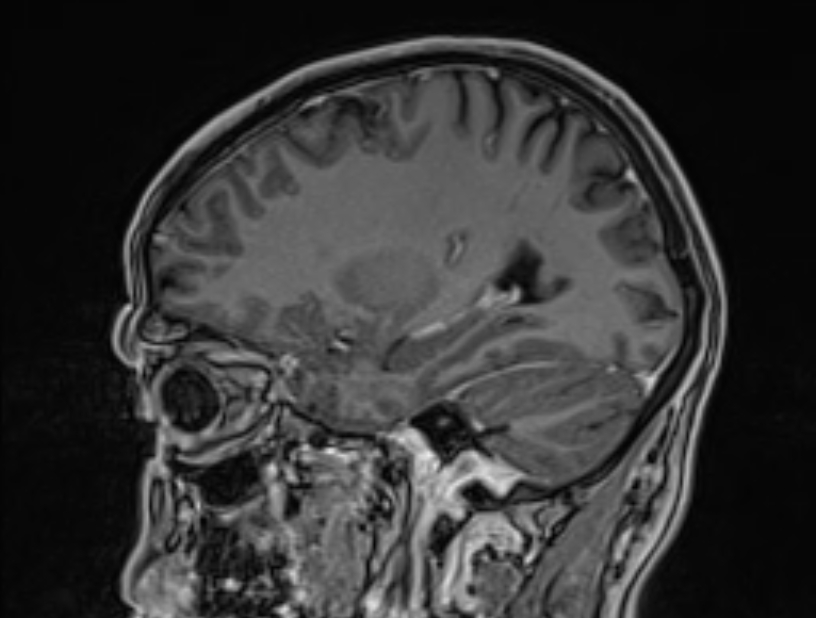 Cerebral venous thrombosis (Radiopaedia 71207-81504 Sagittal T1 C+ 44).jpg