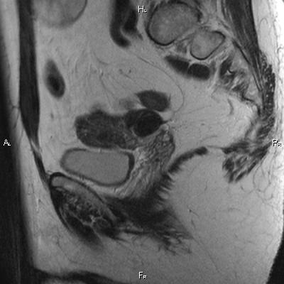 File:Cervical adenocarcinoma (Radiopaedia 65011-73985 Sagittal T2 10).jpg