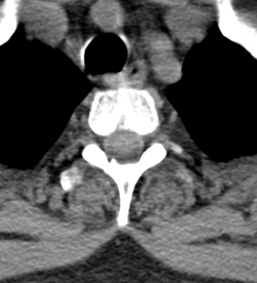 Cervical canal stenosis - OPLL and osteophytes (Radiopaedia 47329-51910 Axial non-contrast 62).png