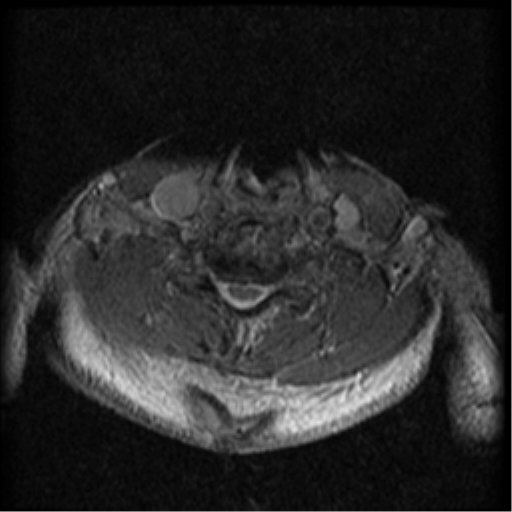 Cervical canal stenosis with cord compression (Radiopaedia 34114-35374 Axial Gradient Echo 34).png