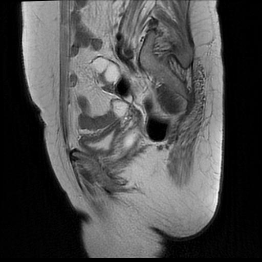 File:Cervical carcinoma (Radiopaedia 88010-104555 Sagittal T2 15).jpg
