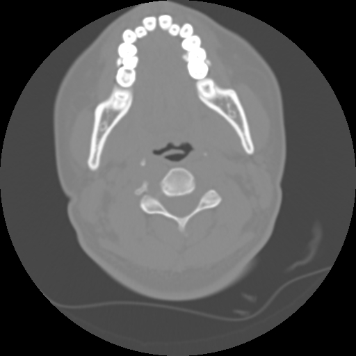 File:Cervical rib (Radiopaedia 71110-81363 Axial non-contrast 27).jpg