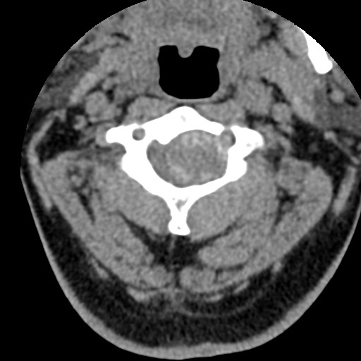 File:Cervical spinal neurofibroma in a patient with NF1 (Radiopaedia 58344-65464 Axial non-contrast 24).jpg
