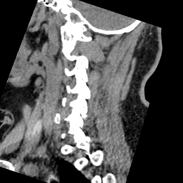 Cervical spinal neurofibroma in a patient with NF1 (Radiopaedia 58344-65464 C 38).jpg
