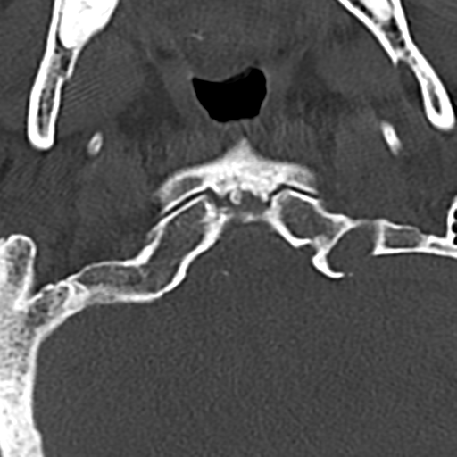 File:Cervical spine fracture - chalk stick (Radiopaedia 39116-41323 Axial bone window 9).png