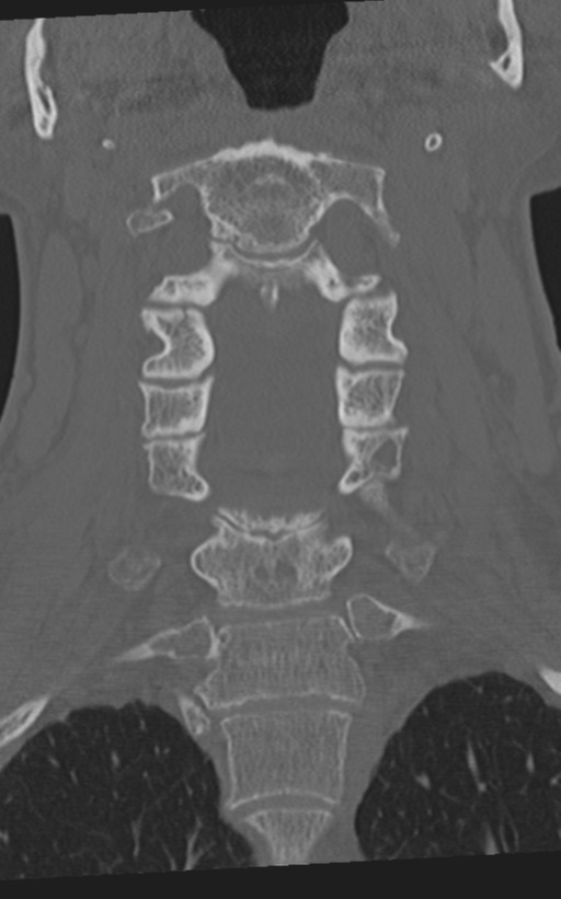 Cervical spine fractures with vertebral artery dissection (Radiopaedia 53296-59268 Coronal bone window 29).png