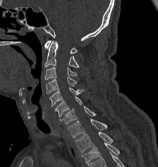 Cervical spine trauma with tear drop fracture and perched facet joint (Radiopaedia 53989-60127 Sagittal bone window 87).jpg