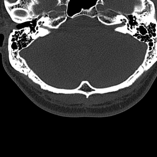 Cervical spondylodiscitis (Radiopaedia 28057-29489 Axial bone window 4).jpg