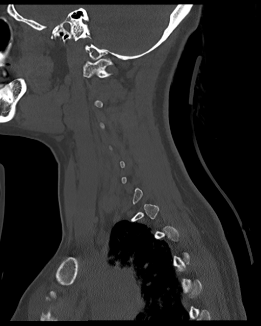 Cervical tuberculous spondylitis (Radiopaedia 39149-41365 Sagittal bone window 52).png