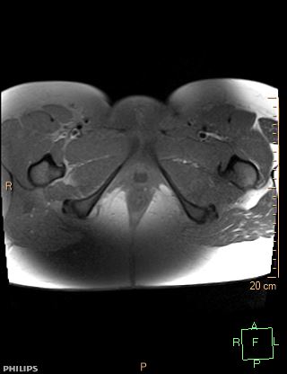 File:Cesarian scar endometriosis (Radiopaedia 68495-78066 Axial T1 fat sat 27).jpg