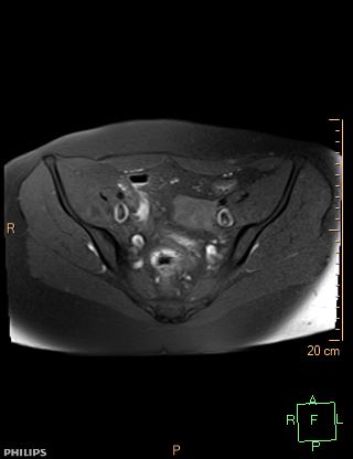 File:Cesarian scar endometriosis (Radiopaedia 68495-78066 Axial T1 fat sat 8).jpg