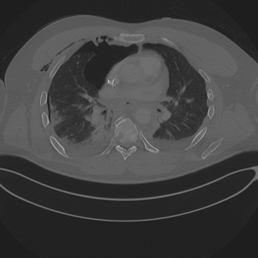 Chest multitrauma - aortic injury (Radiopaedia 34708-36147 Axial bone window 152).png