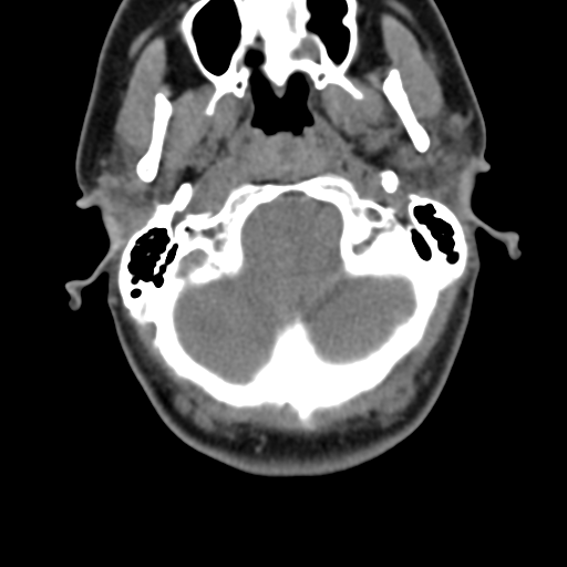 File:Chiari I malformation and obstructive hydrocephalus (Radiopaedia 41185-43981 D 30).png