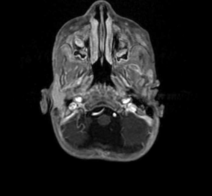 Chiasmatic-hypothalamic glioma (Radiopaedia 90079-107252 Axial T1 C+ 6).jpg