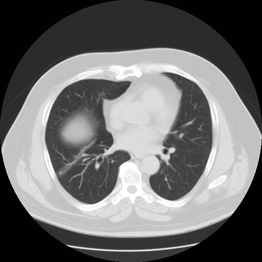 File:Chilaiditi’s syndrome (Radiopaedia 27550-27756 Axial lung window 3).jpg