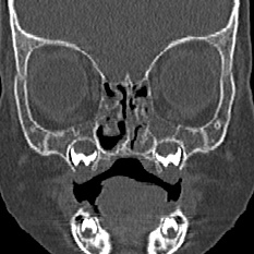 Choanal atresia (Radiopaedia 88525-105975 Coronal bone window 34).jpg
