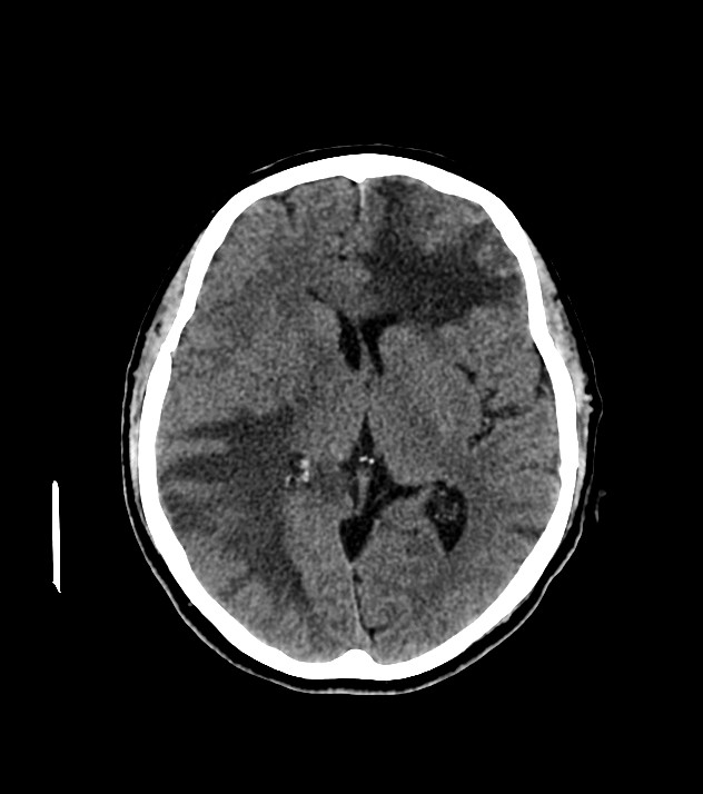 Cholangiocarcinoma with cerebral metastases (Radiopaedia 83519-98628 Axial non-contrast 36).jpg
