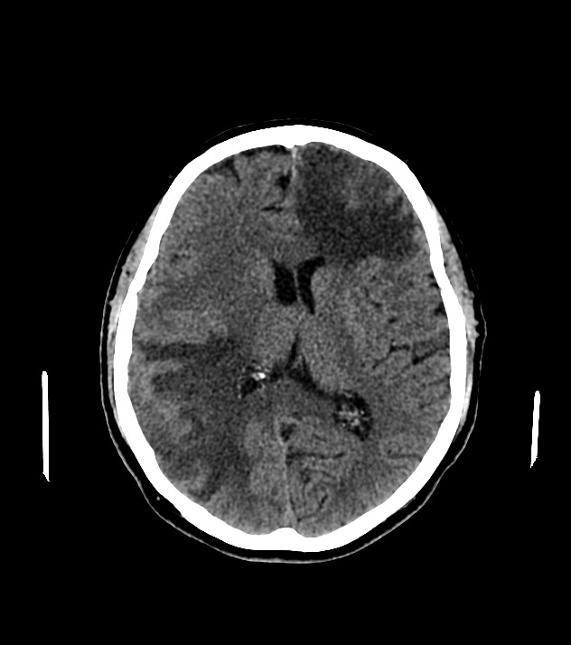 Cholangiocarcinoma with cerebral metastases (Radiopaedia 83519-98628 Axial non-contrast 38).jpg