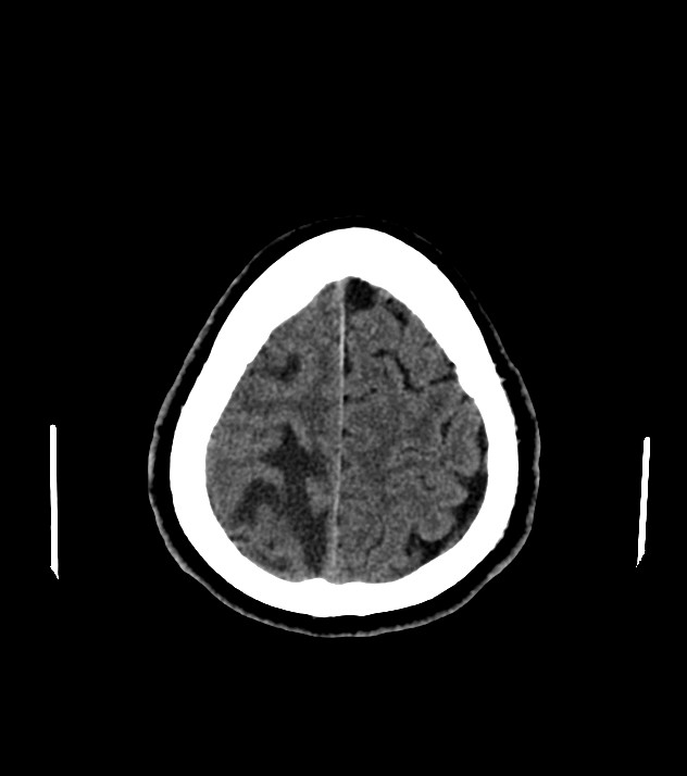 Cholangiocarcinoma with cerebral metastases (Radiopaedia 83519-98628 Axial non-contrast 55).jpg