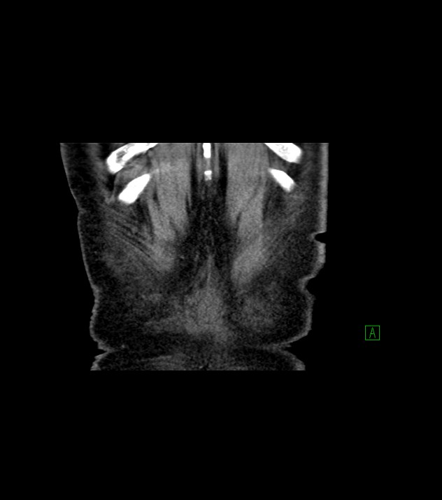 Cholangiocarcinoma with cerebral metastases (Radiopaedia 83519-98629 Coronal C+ delayed 80).jpg