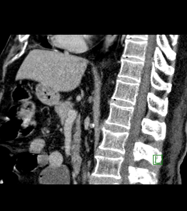 Cholangiocarcinoma with cerebral metastases (Radiopaedia 83519-98629 Sagittal C+ delayed 57).jpg