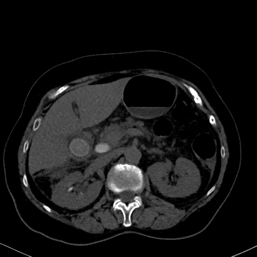 File:Cholecystitis - obstructive choledocholitiasis (CT intravenous cholangiography) (Radiopaedia 43966-47479 Axial 90).png