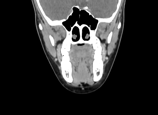 Chondroblastic osteosarcoma (Radiopaedia 67363-76741 D 46).jpg
