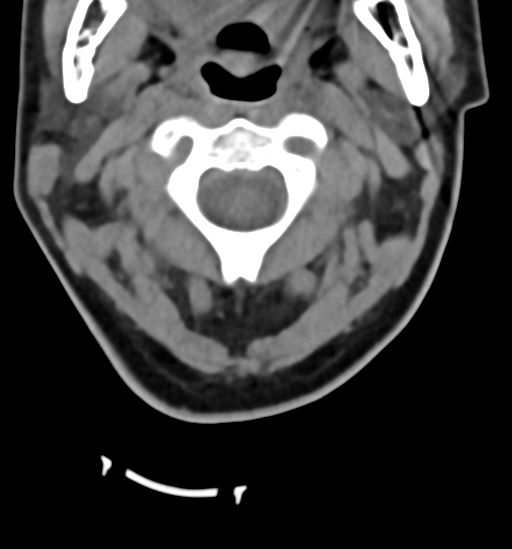 File:Chordoma (C4 vertebra) (Radiopaedia 47561-52188 Axial non-contrast 13).png